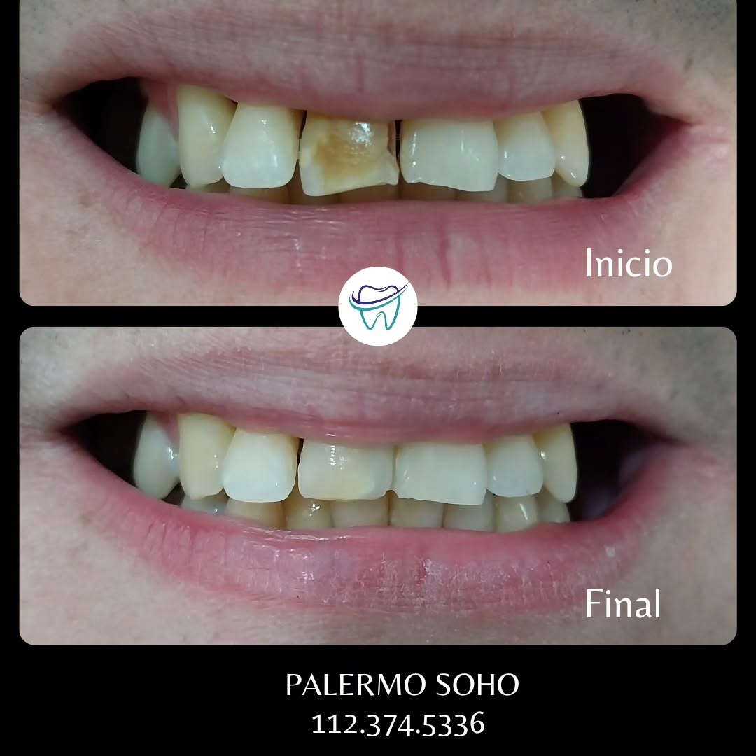 Caso 1 - Antes y Después